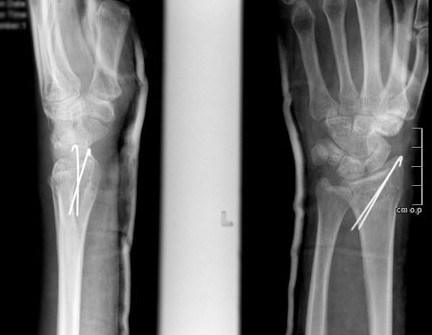 Застарелые, неправильно сросшиеся переломы лучевой кости